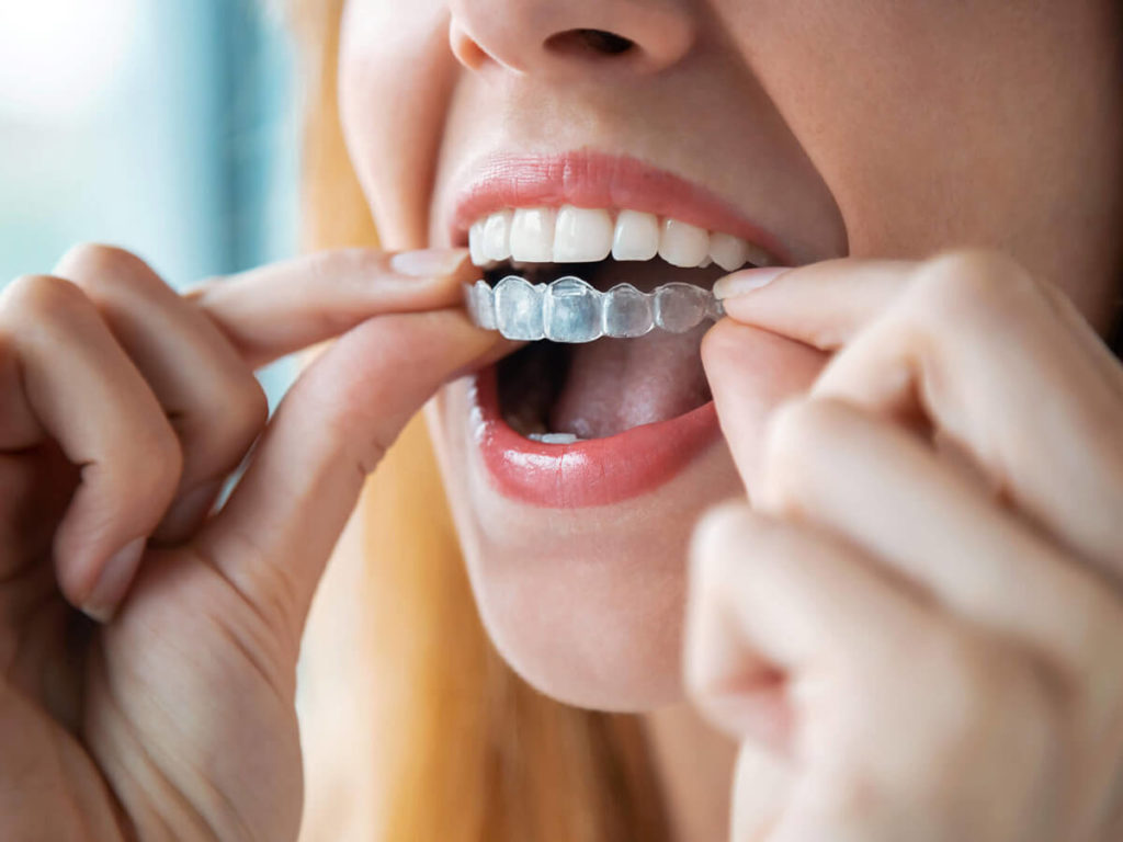 photo of woman putting invisalign aligners on top teeth